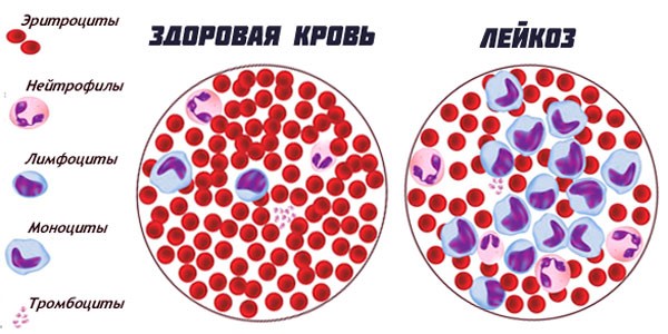 Всемирный день борьбы с Хроническим миелоидным лейкозом